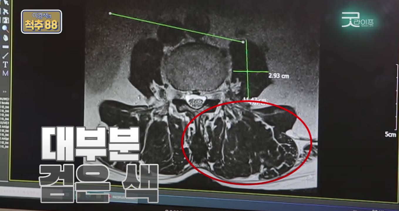 허리디스크 환자에게 코어운동이 중요한 이유(안보면 후회 보장) | 인스티즈