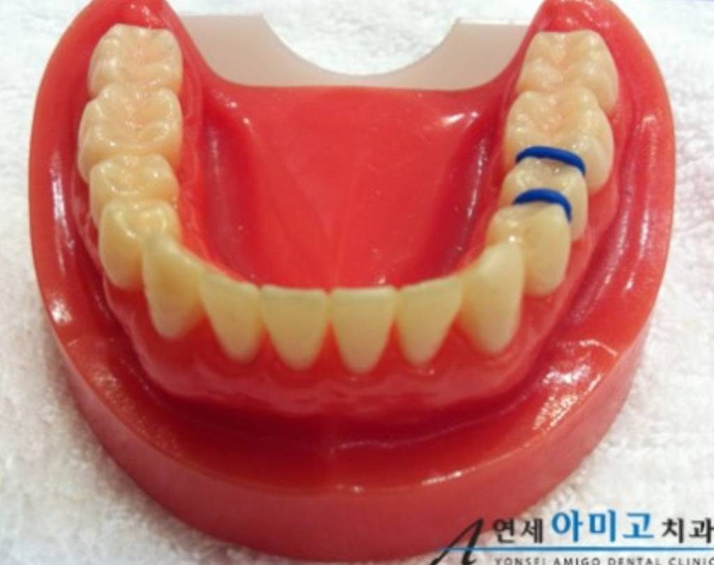 치아교정 극악의 고통류 甲 | 인스티즈