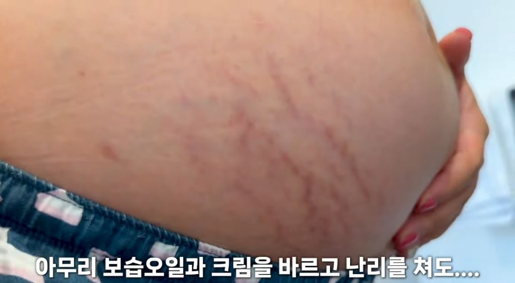 임신 후 몸에 생긴 날것의 변화 | 인스티즈