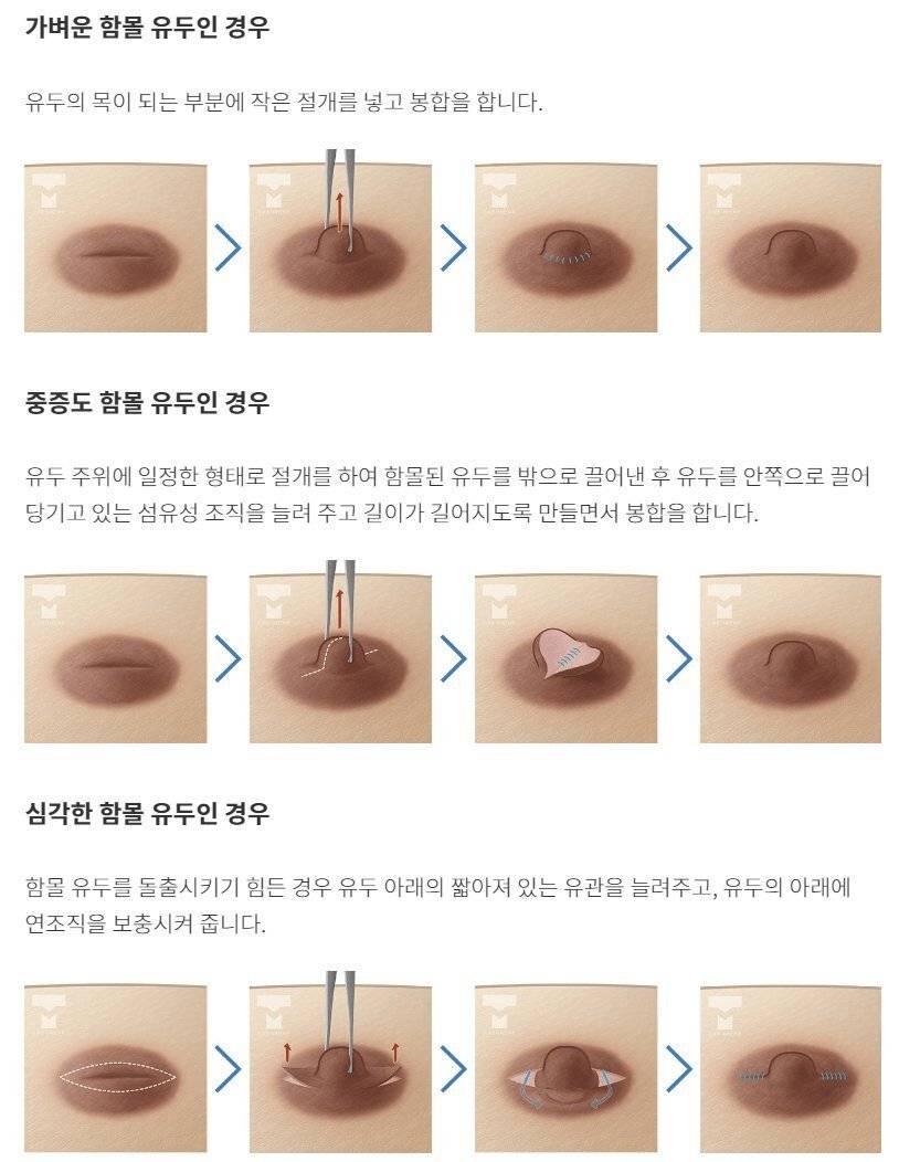 유두 성형수술 종류 | 인스티즈