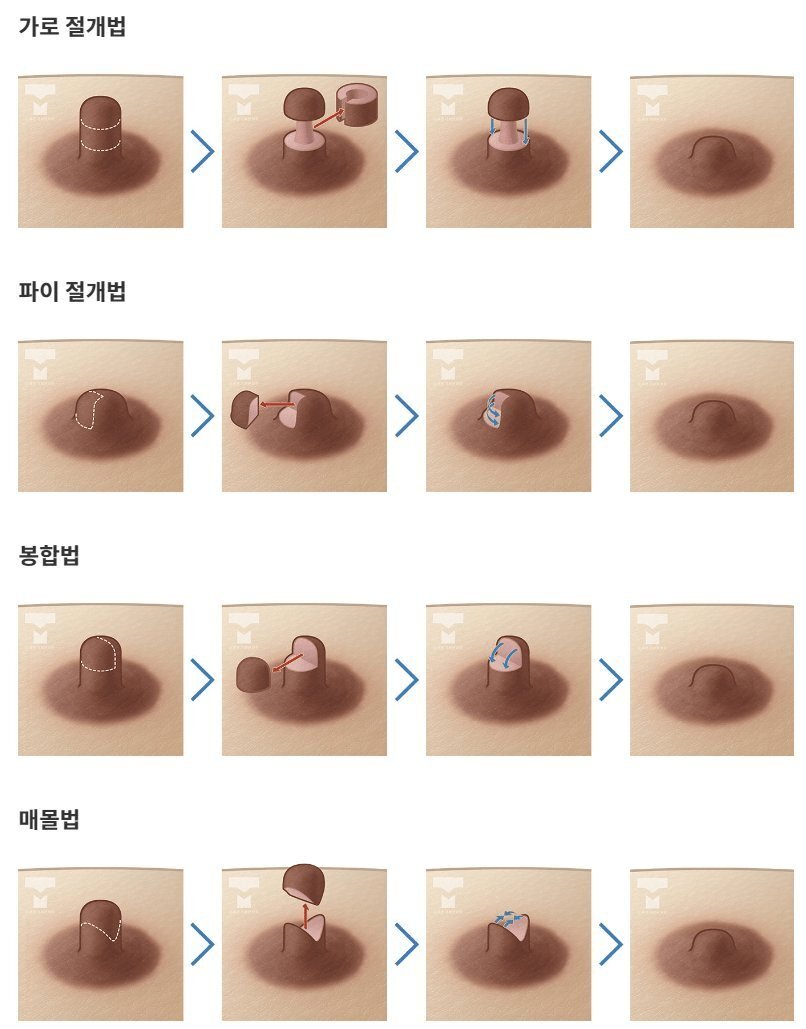 유두 성형수술 종류 | 인스티즈