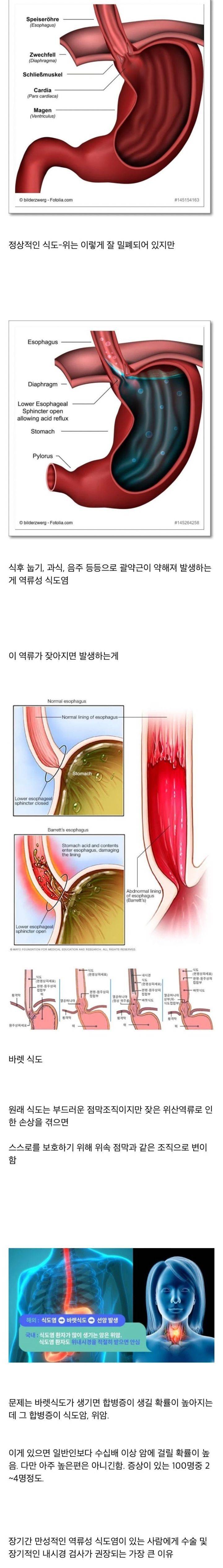 역류성 식도염 있는 사람들이 겪는 신체변화 | 인스티즈
