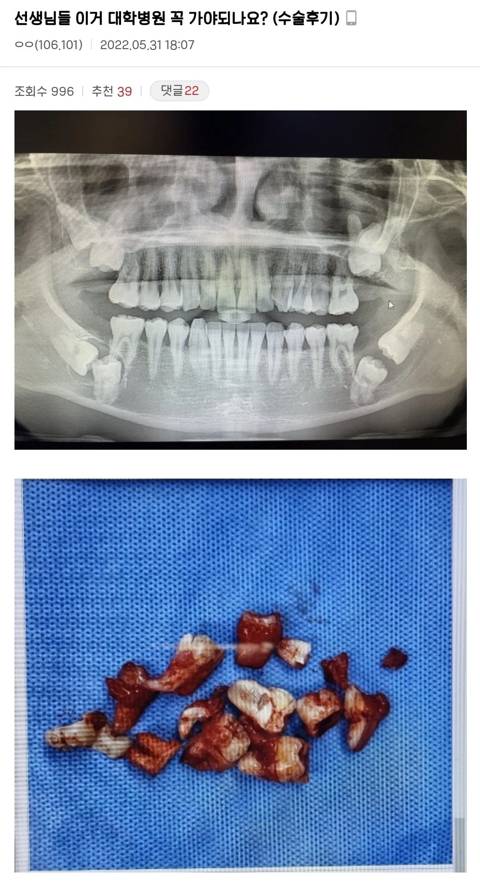 선생님들 이거 대학병원 꼭 가야하나요? 역대급 사랑니 수술후기 | 인스티즈