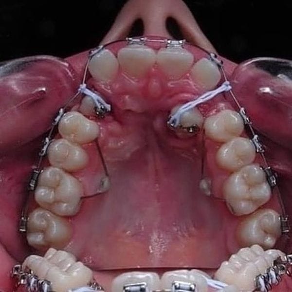 치아교정의 위대함 | 인스티즈