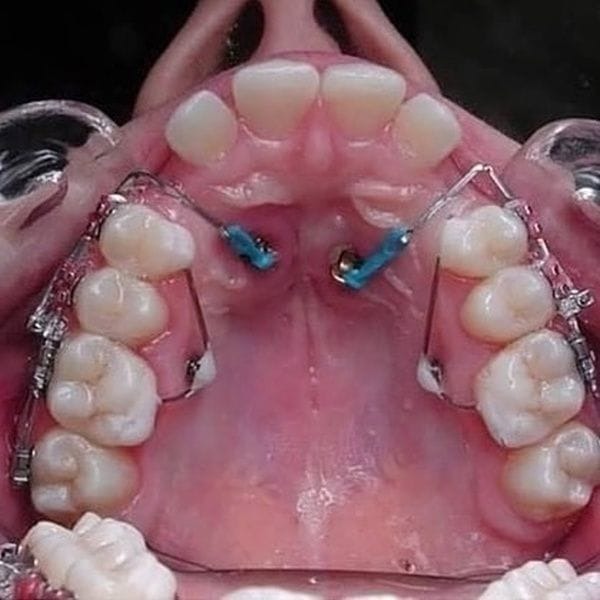 치아교정의 위대함 | 인스티즈
