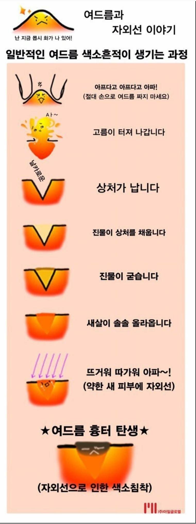 여드름 흉터가 생기는 과정.jpg | 인스티즈