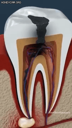 치아신경치료 과정.gif | 인스티즈