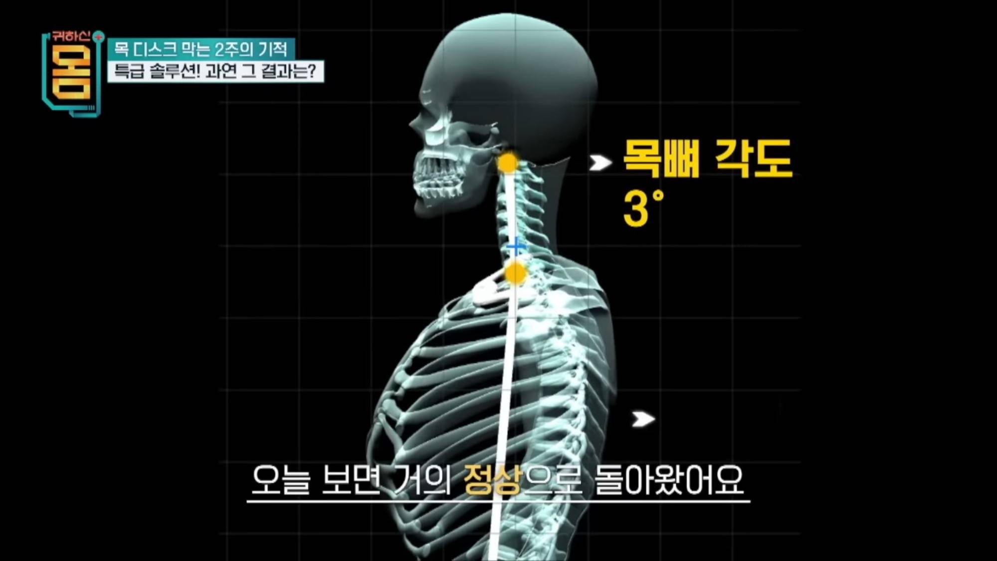 2주만에 효과 대박인 거북목•일자목 마사지&운동 | 인스티즈