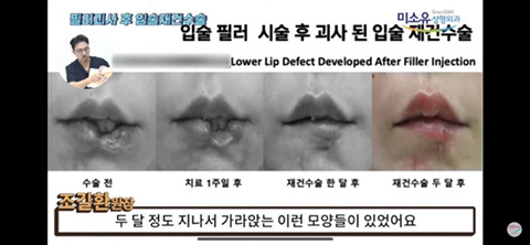 입술필러 잘못 맞고 괴사되는 경우 | 인스티즈