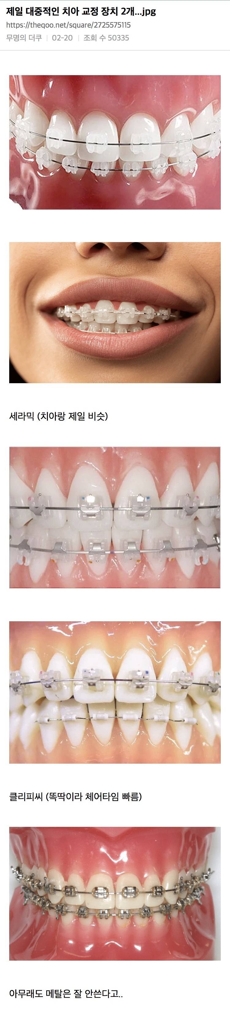 제일 대중적인 치아 교정 장치 2개 | 인스티즈