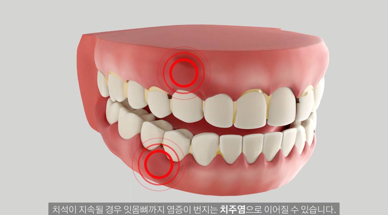 치과의사들이 추천한다는 양치질 방법 | 인스티즈