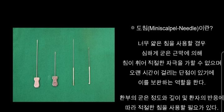 두꺼운 침으로 직접 근육을 찔러서 뭉친 근육 근막 박리시키는 침술... | 인스티즈