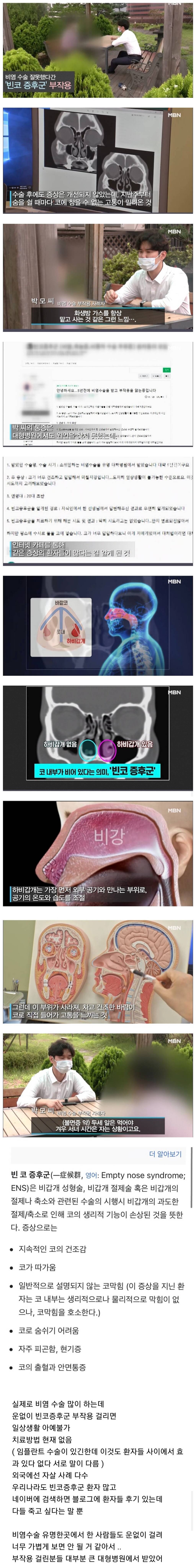 비염수술 치명적인 부작용 | 인스티즈