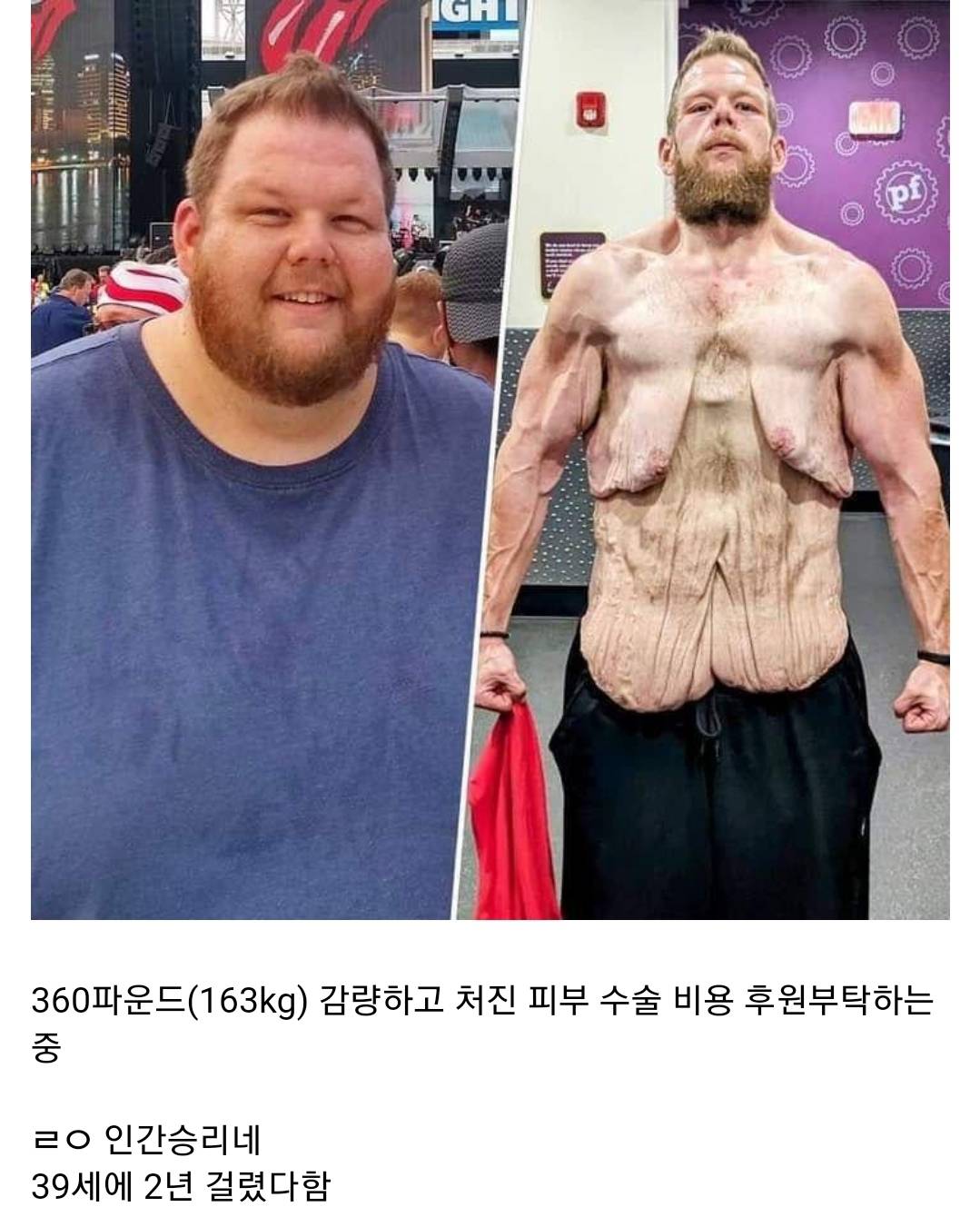 163kg 빼고 부작용이 심하게 온 스트리머 | 인스티즈