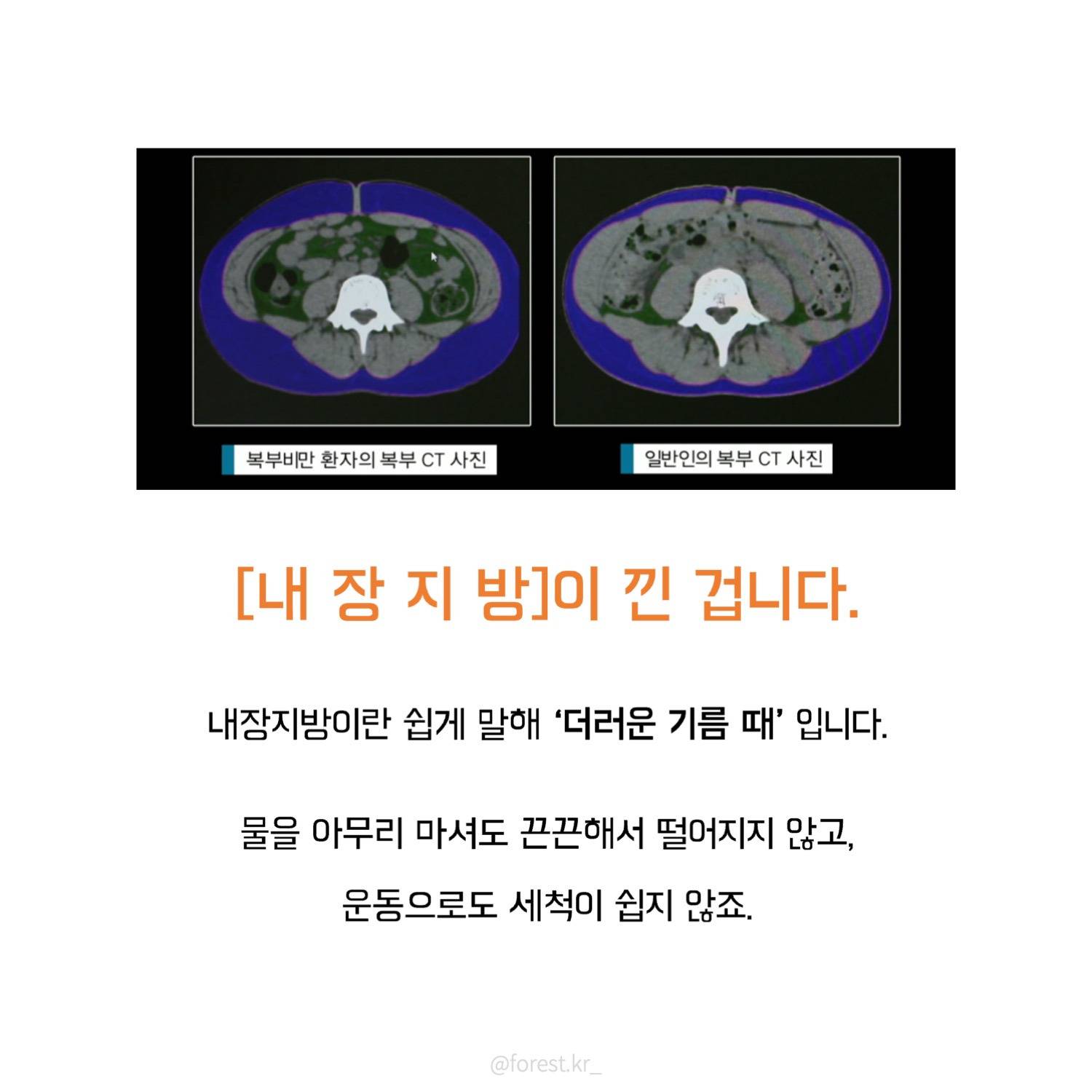 내장지방 전문의가 말하는 충격적인 내장지방 빼는 법...JPG | 인스티즈