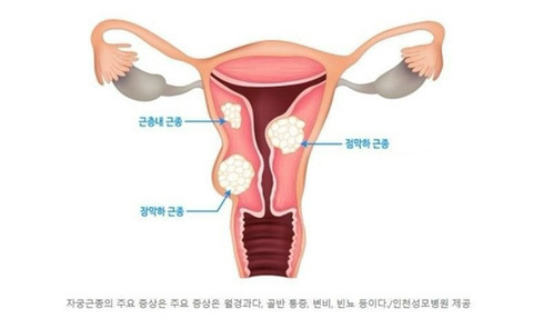 요즘 2030여성들에게 급증하고 있다는 종양 | 인스티즈