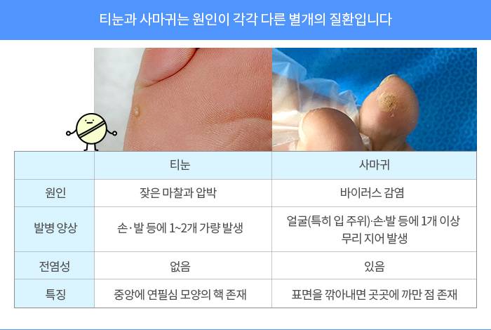 티눈과 사마귀 구별하는 방법.jpg | 인스티즈