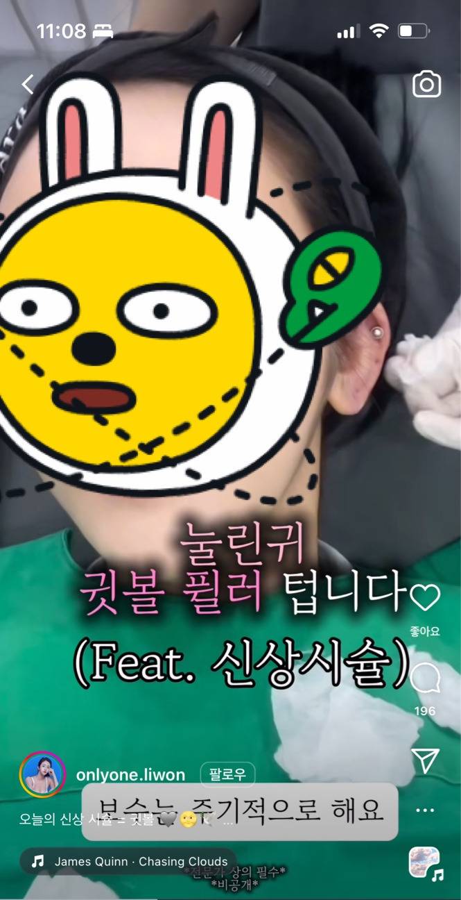 눌린귀 귓볼 필러 시술 전 후 | 인스티즈