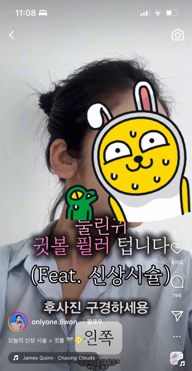 눌린귀 귓볼 필러 시술 전 후 | 인스티즈