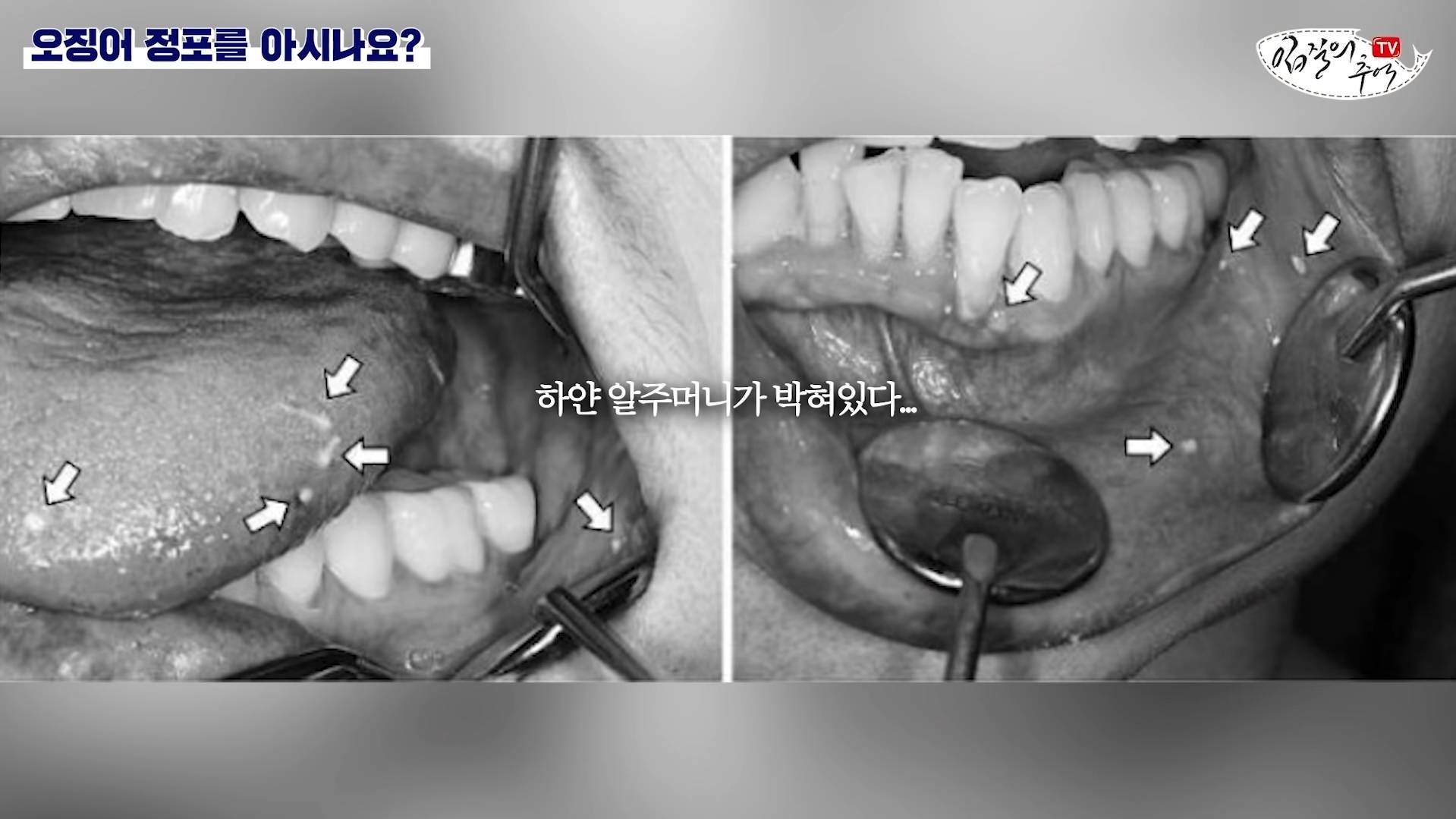 오징어 입 함부로 먹으면 안 되는 이유 (혐) | 인스티즈