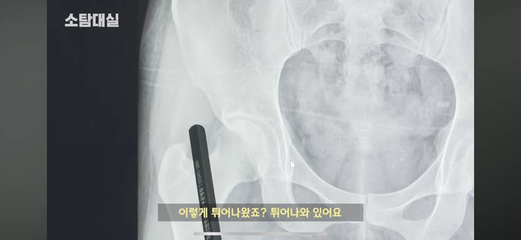 태생부터 다리찢기를 하면 안되는 고관절이 있음 | 인스티즈