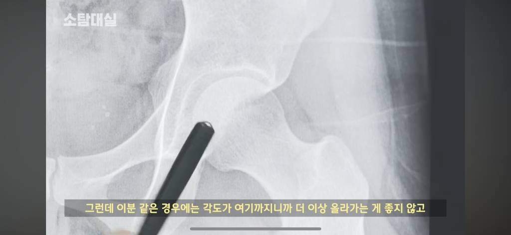 태생부터 다리찢기를 하면 안되는 고관절이 있음 | 인스티즈