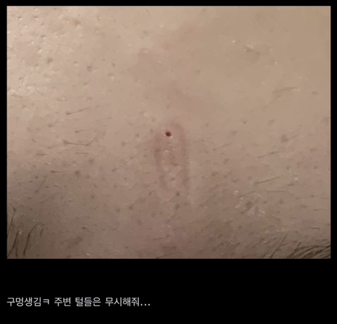 와 이마 중간에 여드름 뽑았는데 구멍 생겼어 | 인스티즈