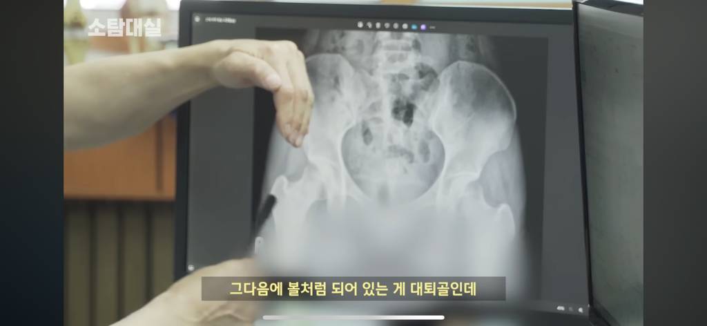 태생부터 다리찢기를 하면 안되는 고관절이 있음 | 인스티즈