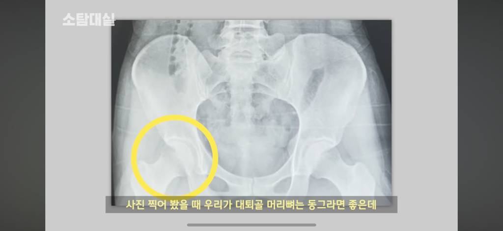 태생부터 다리찢기를 하면 안되는 고관절이 있음 | 인스티즈