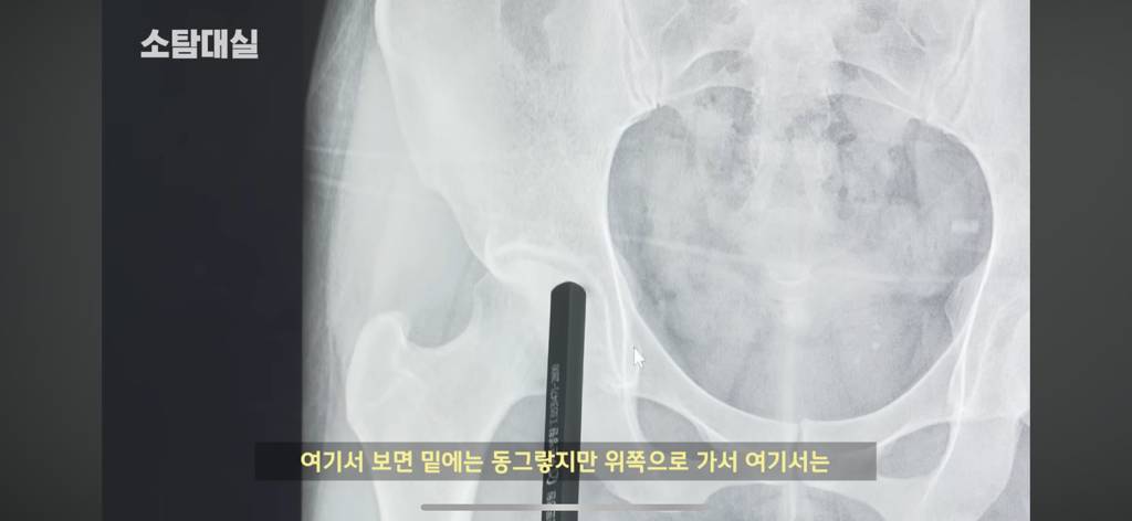 태생부터 다리찢기를 하면 안되는 고관절이 있음 | 인스티즈