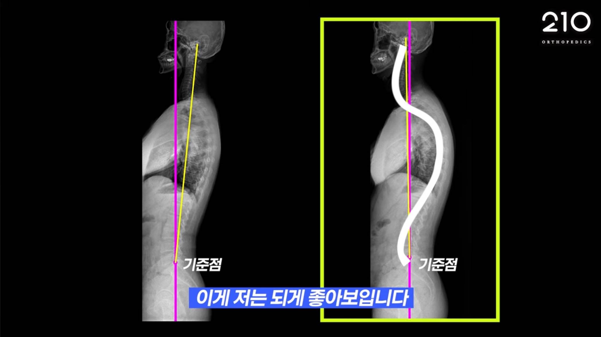 절반은 잘못알고 있다는 라운드숄더의 진실 | 인스티즈