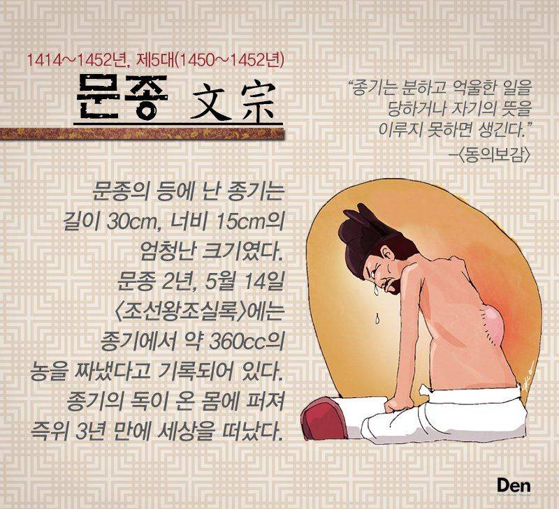 내 등이 다 아픈 조선 5대왕 문종의 등창 크기 | 인스티즈