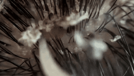 혐주의) 두피염 각질 제거....gif | 인스티즈