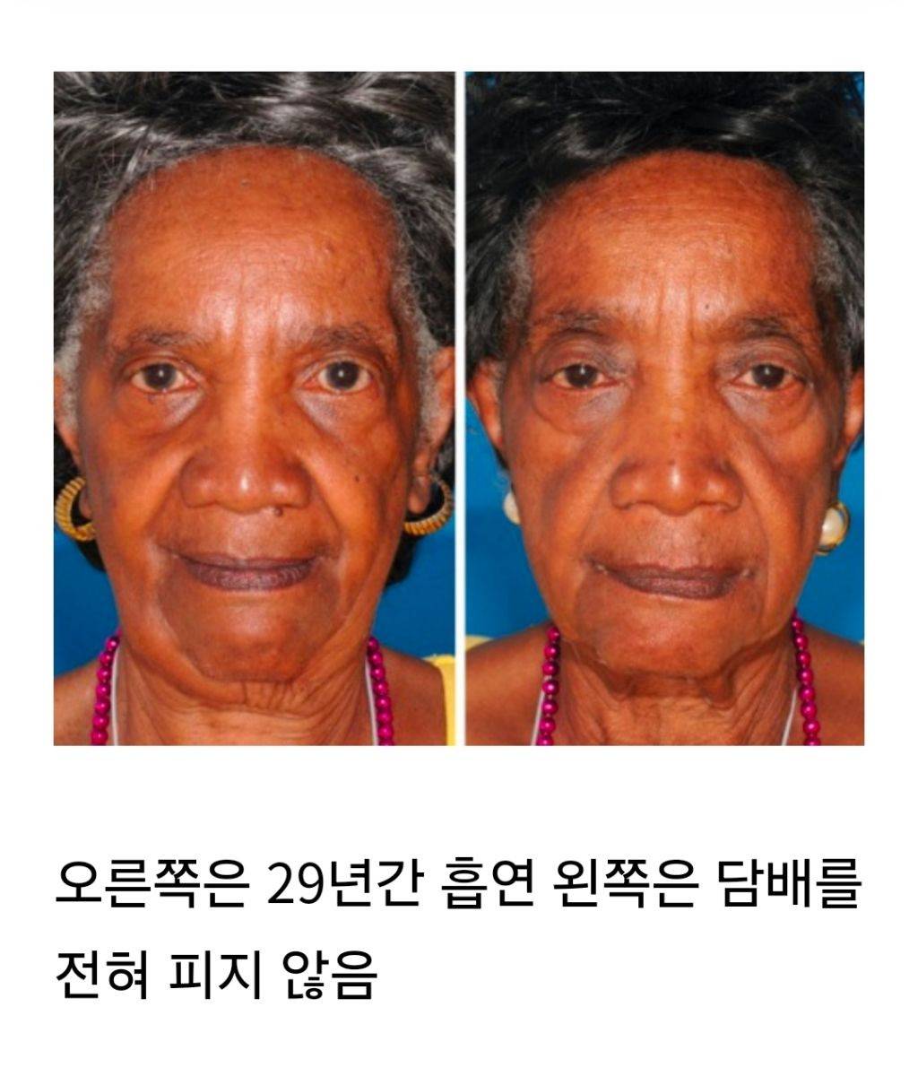 일란성 쌍둥이로 비교한 노화 - 담배, 스트레스, 햇빛, 체중변화 | 인스티즈