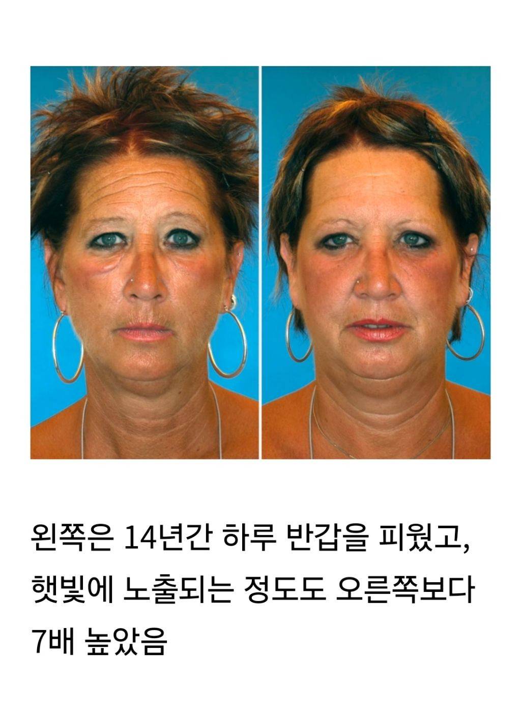 일란성 쌍둥이로 비교한 노화 - 담배, 스트레스, 햇빛, 체중변화 | 인스티즈