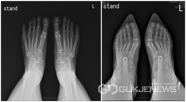 하이힐 신은 발 엑스레이 | 인스티즈