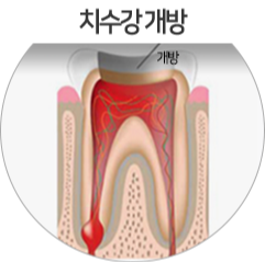 충치치료할때 뜯어내는 신경조직들.jpg | 인스티즈