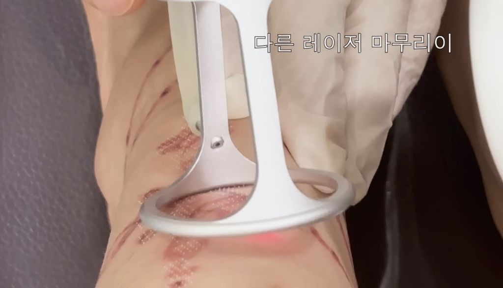 타투 제거 브이로그 올린 나나 | 인스티즈