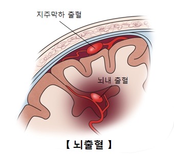 뇌졸중에 대해 알아보자 (장문 주의, 그래도 읽어 줘) | 인스티즈