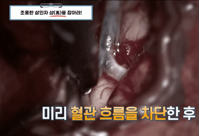 뇌 혈전 제거 모습 | 인스티즈