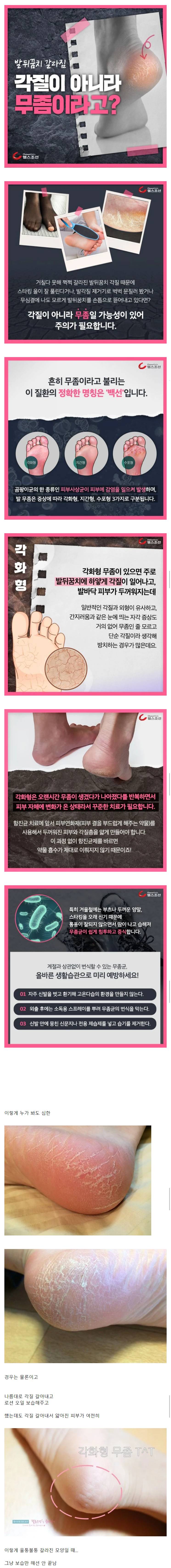 발뒤꿈치 갈라짐, 각질이 아니라 무좀이라고? | 인스티즈