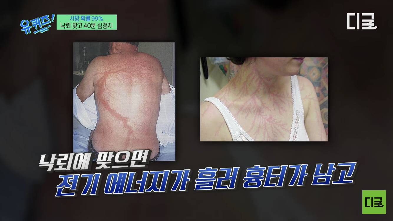 낙뢰맞고 40분간 심정지 후 모든 피가 새어나왔지만, 기적같이 살아남으신 분 | 인스티즈