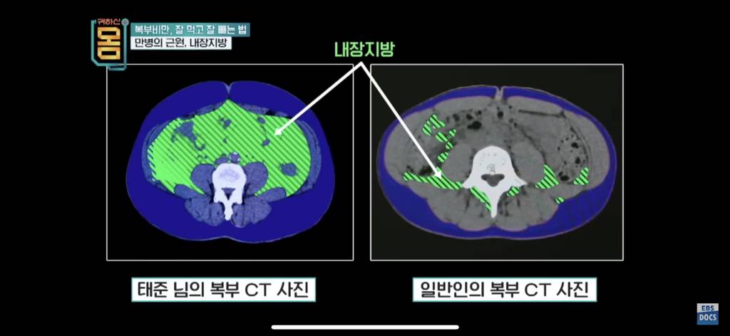 [EBS] 귀하신몸 - 복부비만 잘 먹고 잘 빼는 법 (16일동안 허리둘레 22cm 감소) | 인스티즈