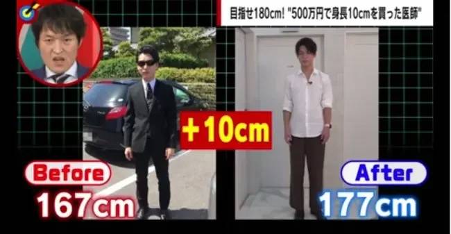 일본, 키 크는 수술로 무려 10cm나 키운 피부과 의사 | 인스티즈