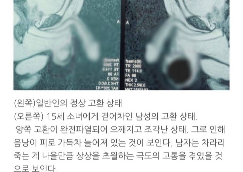 발레를 배워야 하는 이유 (고환 파열) | 인스티즈
