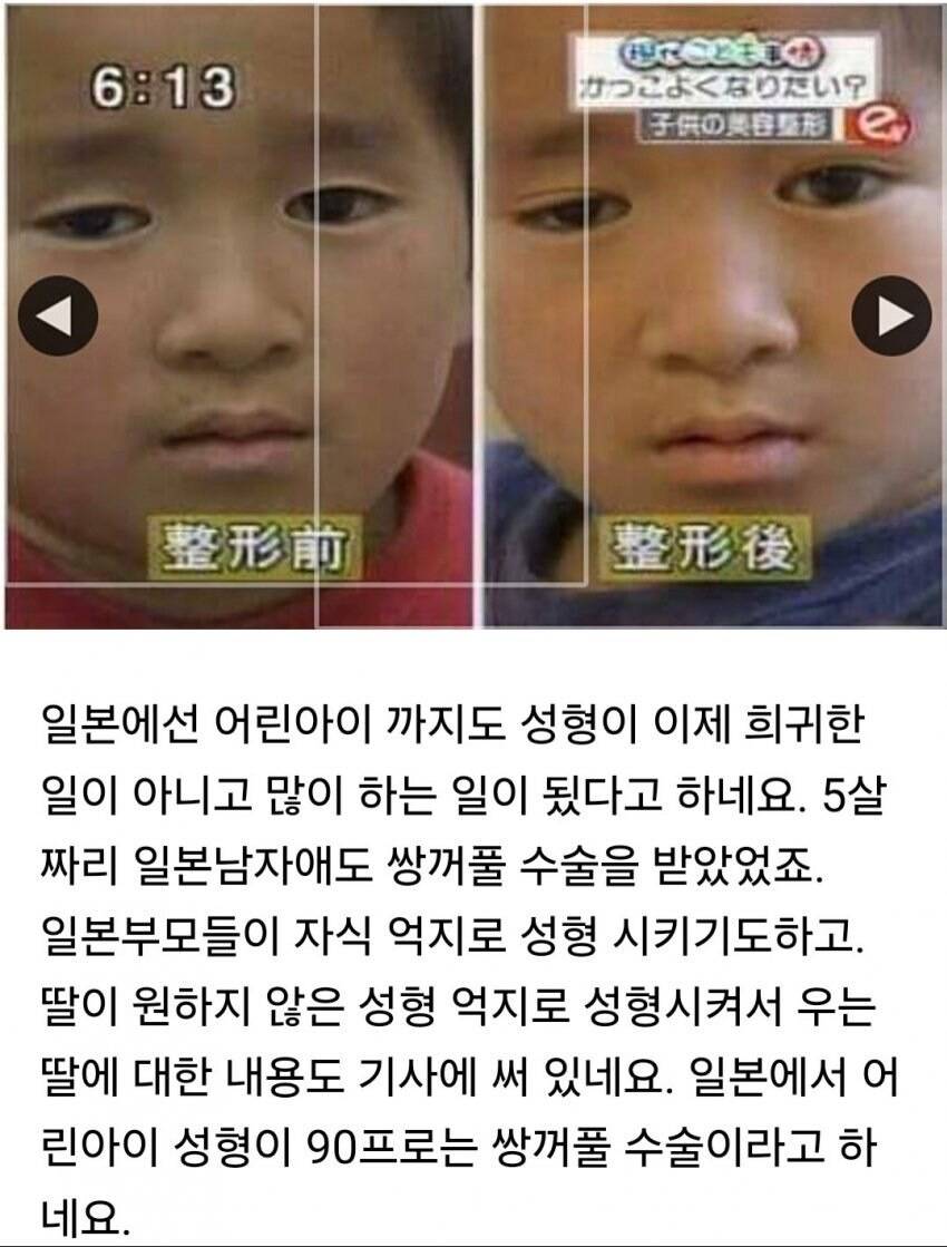 쌍꺼풀 성형수술 받은 일본 초등학생.jpg | 인스티즈