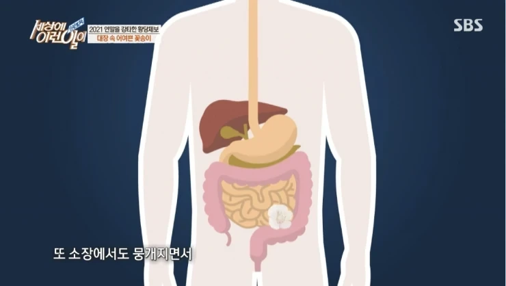 대장내시경하다 발견된거 | 인스티즈