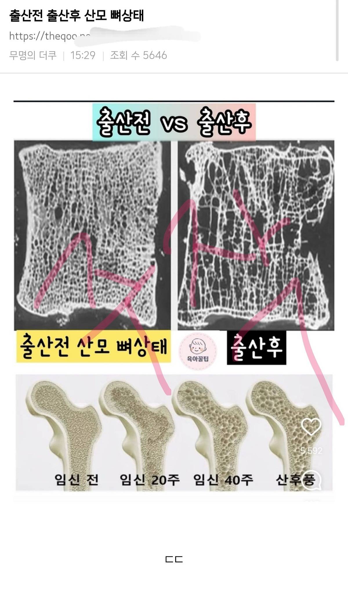 ‼️출산전 출산후 산모 뼈상태라고 돌아다니는 짤 주작임‼️ | 인스티즈