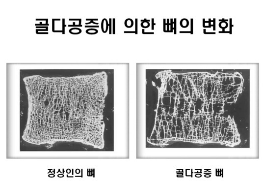 ‼️출산전 출산후 산모 뼈상태라고 돌아다니는 짤 주작임‼️ | 인스티즈