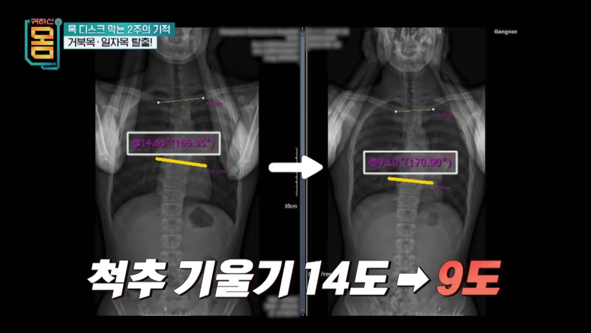 2주만에 효과 대박인 거북목•일자목 마사지&운동 | 인스티즈